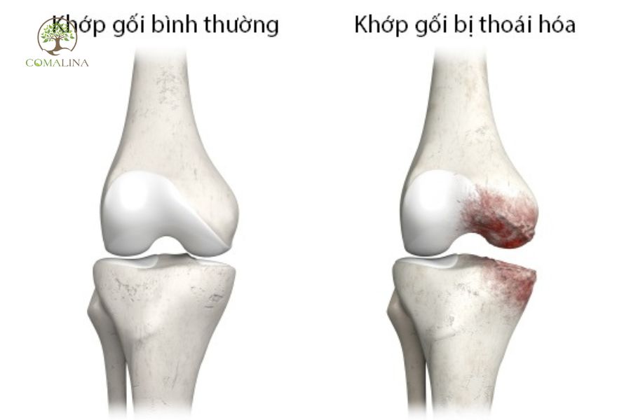 Thoái hoá khớp gối là gì
