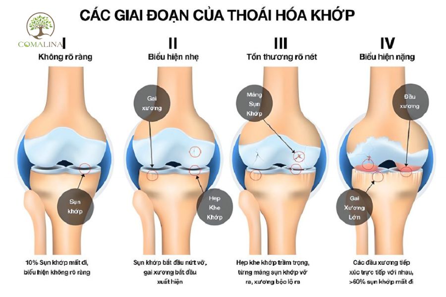 Thoái hoá khớp gối là gì